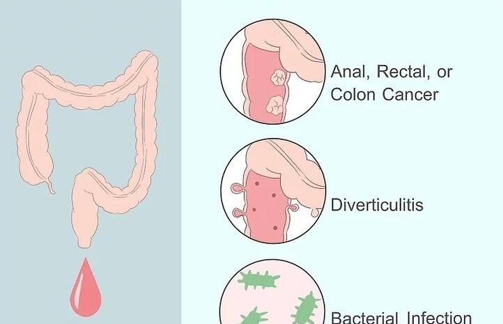什么是便血？便血的原因有哪些，拉血便怎么办