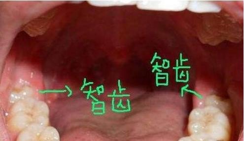 拔了智齿要注意什么,智齿掉了怎么办