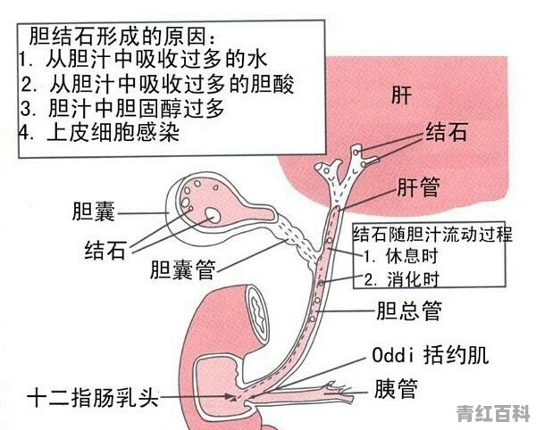 胆结石需要注意些什么