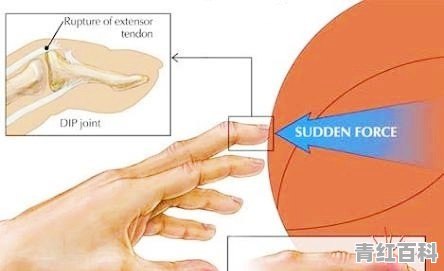 手指打球戳伤半年了 关节变粗怎么恢复 拍过片骨头没问题