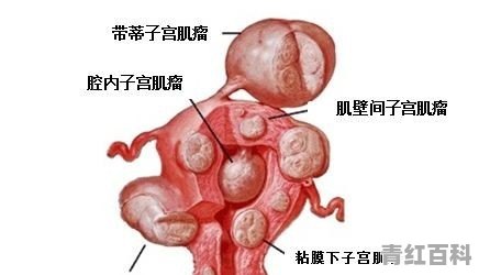 我的宫颈肌瘤如何治疗好？需要做手术吗