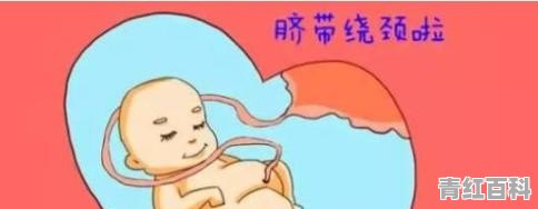 脐带绕颈怎么办