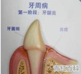 牙周炎根尖炎如何治疗方法