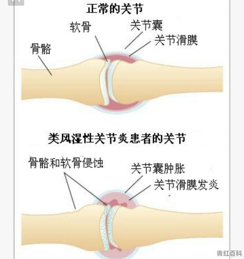 类风湿好发在身体的哪些部位