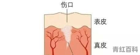 乳头碰坏了，伤口总是不愈合怎么办