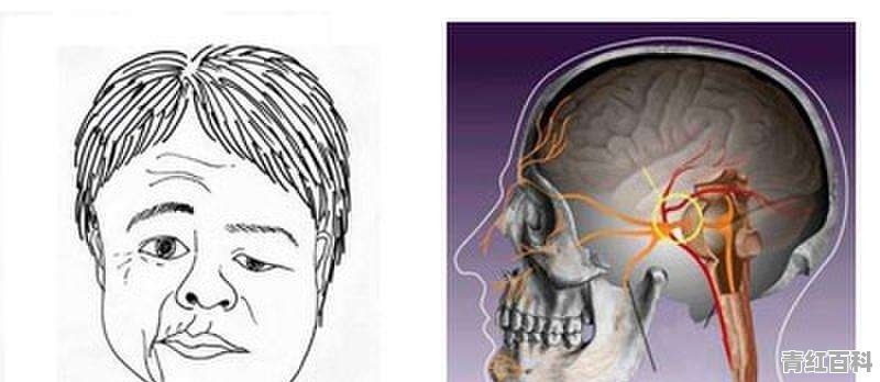 面瘫不治疗可以自愈吗