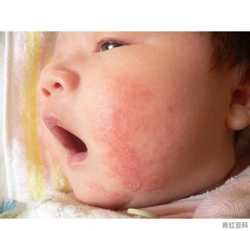 1岁湿疹怎么办