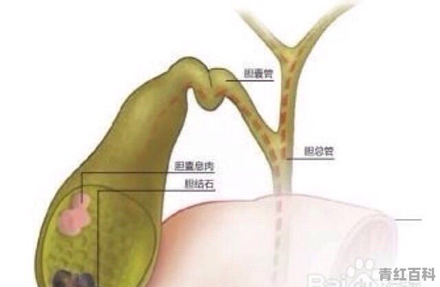 胆囊息肉会因起后背痛吗